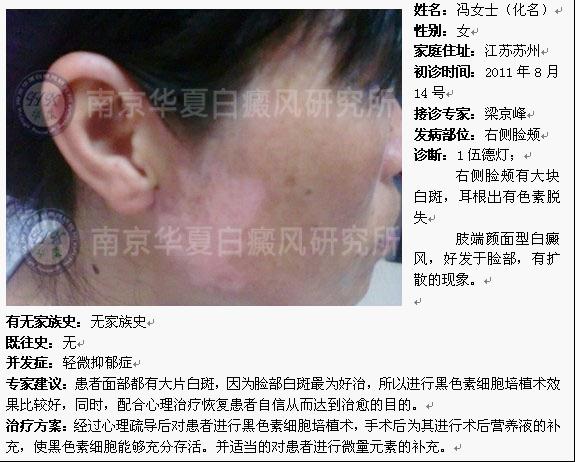 南京华厦白癜风恢复病例1.jpg